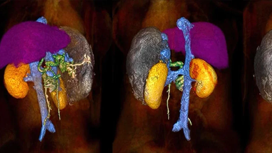 3D printing of organs