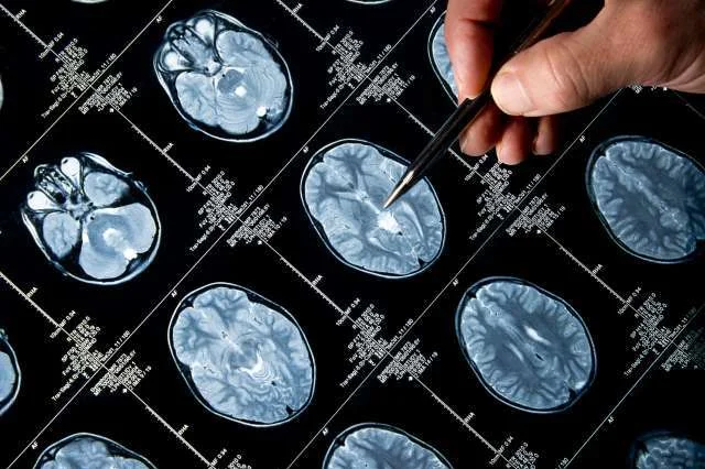 Physician pointing at brain images with pen